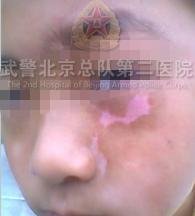 经过一段时间的治疗,小康面部白斑明显消退 经过一段时间的治疗,小康面部白斑明显消退