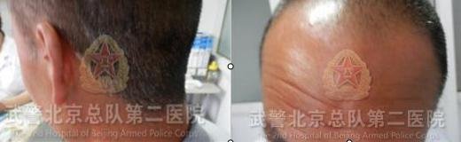 经过一段时间的治疗后,白斑明显褪去,恢复效果良好 经过一段时间的治疗后,白斑明显褪去,恢复效果良好