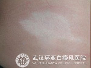 白癜风早期症状有哪些