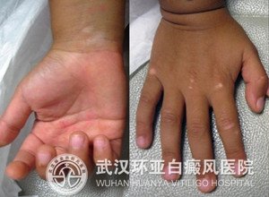 夏季白癜风扩散怎么办