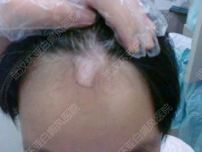 女孩额头白斑坚持早发现,早治疗