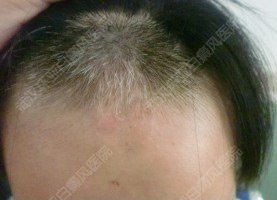 女孩额头白斑坚持早发现,早治疗