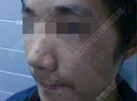 少年与青少年过渡时,面部颈部出现明显白斑