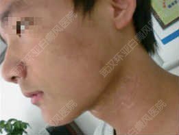 少年与青少年过渡时,面部颈部出现明显白斑
