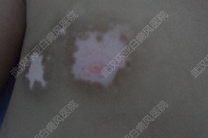 4岁儿童胸部出现白斑2个月