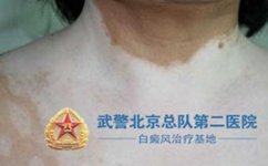 治疗白癜风用什么技术好 治疗白癜风用什么技术好