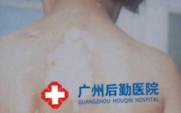 白癜风症状有哪些表现