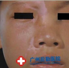 儿童白癜风能够治疗吗