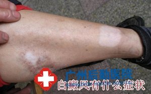 白癜风诊断依据有哪些