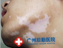 儿童白癜风患者注意什么 儿童白癜风患者注意什么