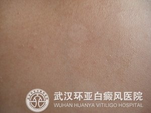 白癜风有哪些发病原因