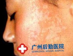 脸上有白癜风病因是什么