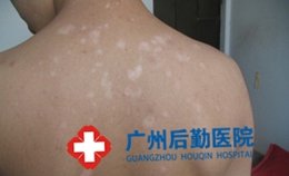怎么确诊是白癜风还是老年斑 怎么确诊是白癜风还是老年斑