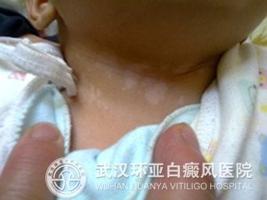 儿童白癜风的治疗该怎么办