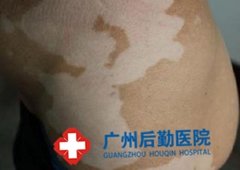 广州哪家医院治疗白癜风好 广州哪家医院治疗白癜风好