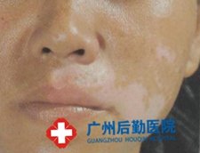 广州哪里有看白癜风的医院 广州哪里有看白癜风的医院