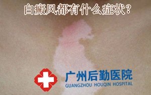 局限型白癜风的常识 局限型白癜风的常识