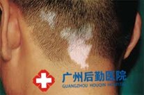白癜风患者睡眠不足有哪些危害 白癜风患者睡眠不足有哪些危害