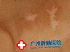广州市哪家医院治疗白癜风效果好 广州市哪家医院治疗白癜风效果好