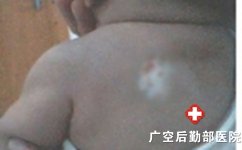 广州白癜风去哪家医院好 广州白癜风去哪家医院好