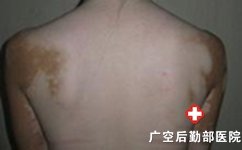 为什么白癜风不容易治疗 为什么白癜风不容易治疗