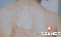 广州白癜风医院有那几家 广州白癜风医院有那几家
