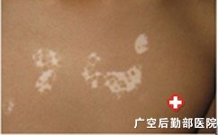广州有没有专治白癜风医院 广州有没有专治白癜风医院