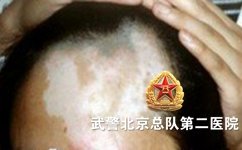 白癜风和哪些体内激素有关 白癜风和哪些体内激素有关