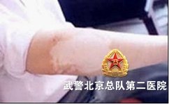 白癜风如何与无色素痣区分开 白癜风如何与无色素痣区分开