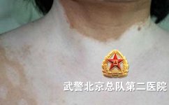 白癜风治疗好转后的症状有哪些 白癜风治疗好转后的症状有哪些