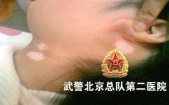 不同类型的白癜风的症状 不同类型的白癜风的症状
