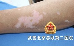 怎么分辨白癜风的症状 怎么分辨白癜风的症状