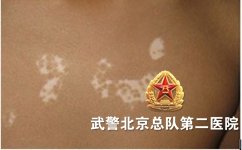 北京有治疗白癜风的医院吗 北京有治疗白癜风的医院吗
