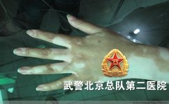 白癜风的并发症有哪些 白癜风的并发症有哪些