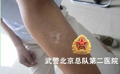 白癜风的治疗有哪些慎用药 白癜风的治疗有哪些慎用药