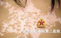 北京哪里治疗白癜风比较好 北京哪里治疗白癜风比较好