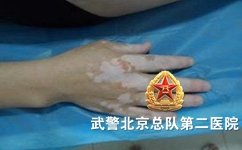 北京那家医院治疗白癜风好 北京那家医院治疗白癜风好