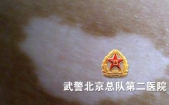 北京有治白癜风医院吗 北京有治白癜风医院吗