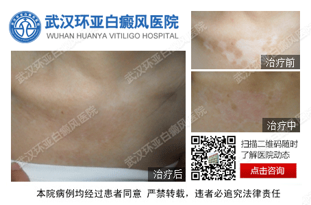 武汉专业治白癜风的医院