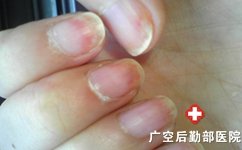 患上白癜风是什么样的症状 患上白癜风是什么样的症状