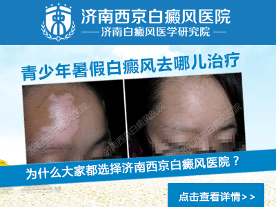 济南有能治白癜风的医院吗 济南有能治白癜风的医院吗