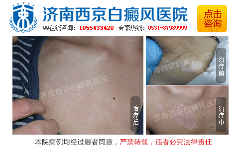 山东省治疗白癜风的医院有哪些 山东省治疗白癜风的医院有哪些