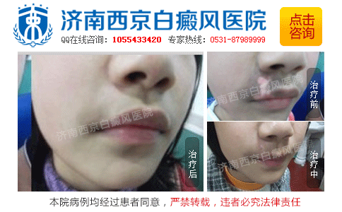 济南哪里治疗白癜风有效果 济南哪里治疗白癜风有效果