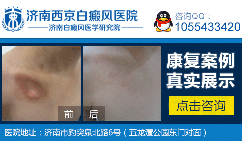 山东白癜风哪个医院好 山东白癜风哪个医院好