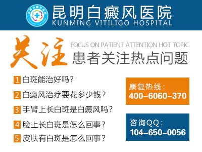 昆明治白癜风到哪家医院