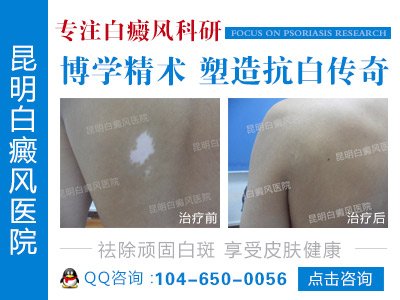 昆明治白癜风好的医院