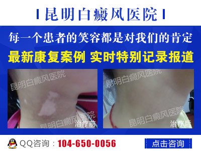 昆明治白癜风的医生