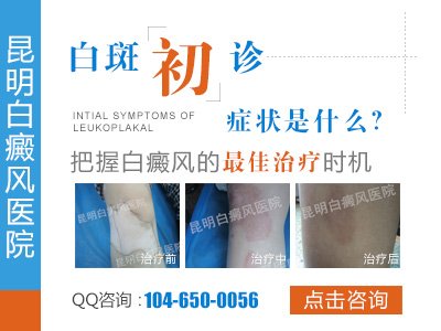 昆明治白癜风哪个医院治的好