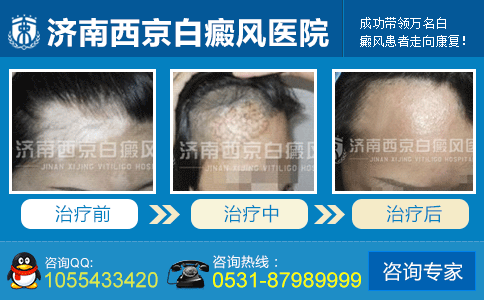 济南专科医院哪里治白癜风好 济南专科医院哪里治白癜风好