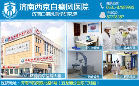 山东治白癜风哪个医院好 山东治白癜风哪个医院好